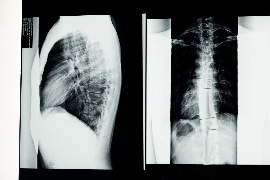 osteochondróza krčnej chrbtice na obrázku