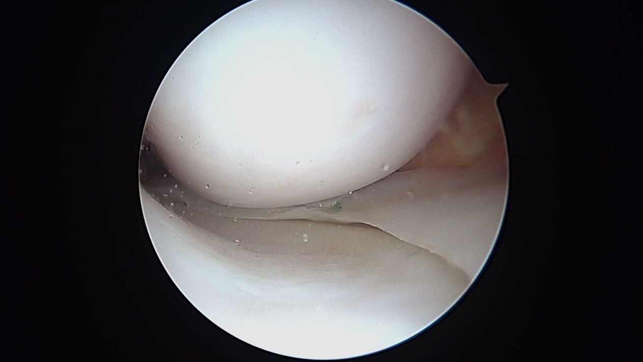 pohľad na kolenný kĺb cez artroskop