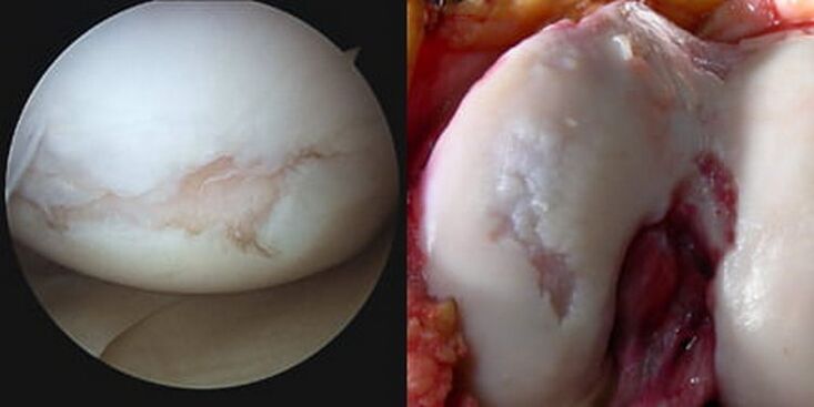 počas operácie je viditeľné poškodenie kolenného kĺbu