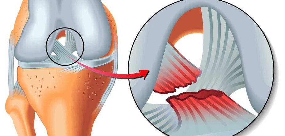 zranený kolenný kĺb