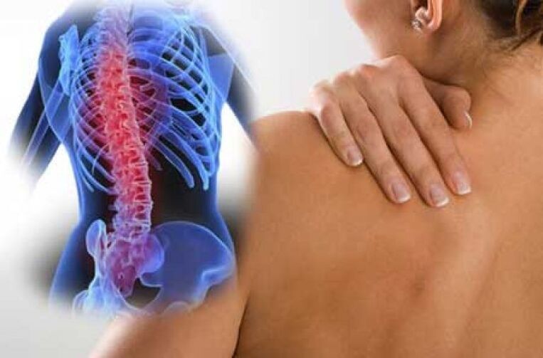 Pri osteochondróze môže bolesť vyžarovať do vzdialených častí tela