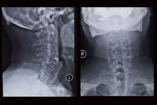 RTG snímka krčnej chrbtice (pacient má osteochondrózu)
