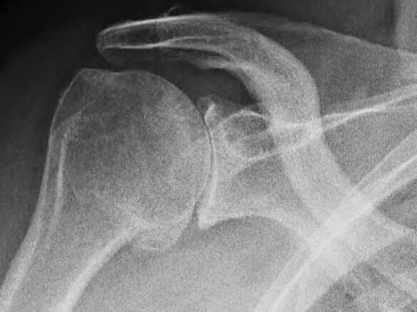 RTG ramenného kĺbu postihnutého artrózou