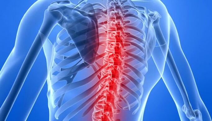 Patológie chrbtice sú najčastejšími príčinami bolesti chrbta v oblasti lopatky