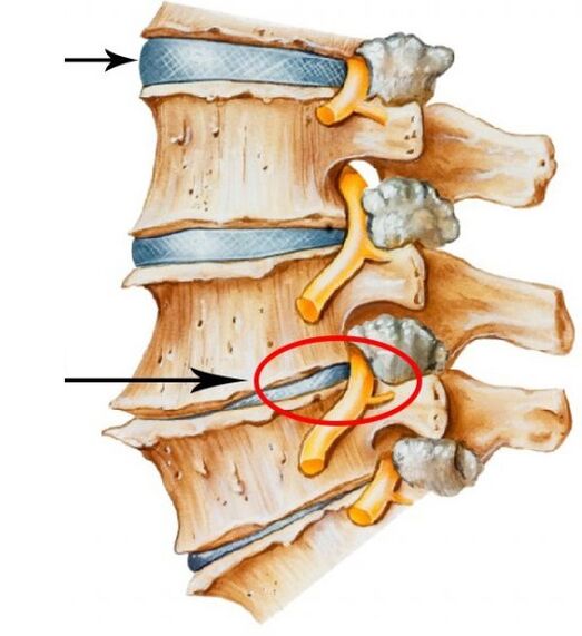 cervikálna osteochondróza