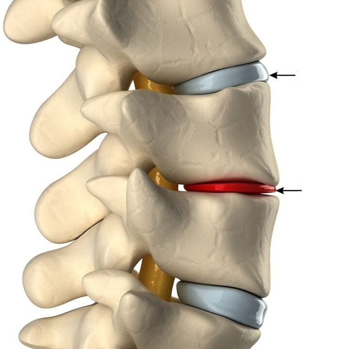 Rozdiel medzi zdravým diskom a diskom s osteochondrózou