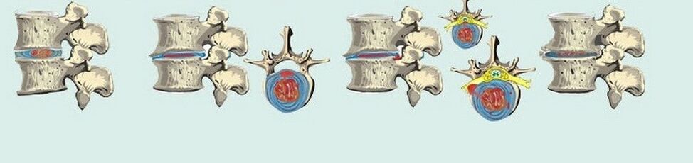 Rôzne štádiá hrudnej osteochondrózy