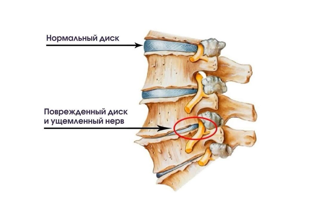 Príznaky cervikálnej osteochondrózy