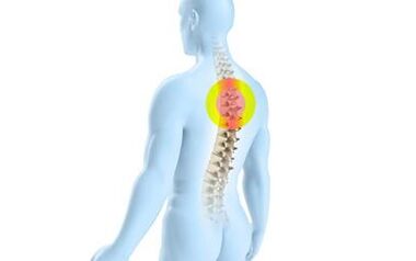 osteochondróza hrudnej chrbtice