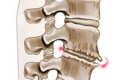 poškodenie stavcov pri hrudnej osteochondróze