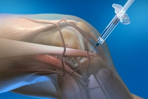 intraartikulárne injekcie na artrózu kolenného kĺbu