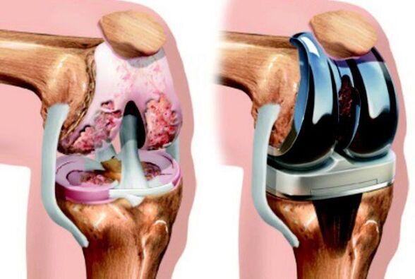 pred a po artróze kolenného kĺbu pre artrózu